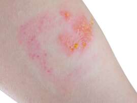 9 Home Remedies To Reduce Rashes on Inner Thighs