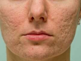 9 Best Products For Acne Scars 2023