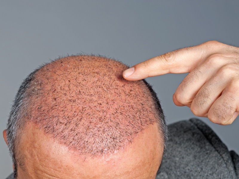 9 Best Hair Transplant Centers In Kerala | Styles At Life