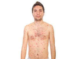 Chickenpox (Varicella): Signs, Symptoms, Causes and Complications.