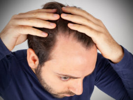 Hair Loss Due to Hormonal Imbalance – How to treat?