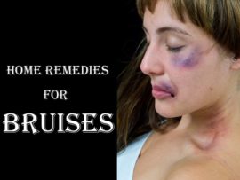 14 Best Home Remedies for Bruises: How Do They Work?