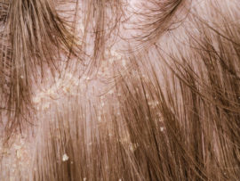 How to Remove Dandruff from Hair Permanently