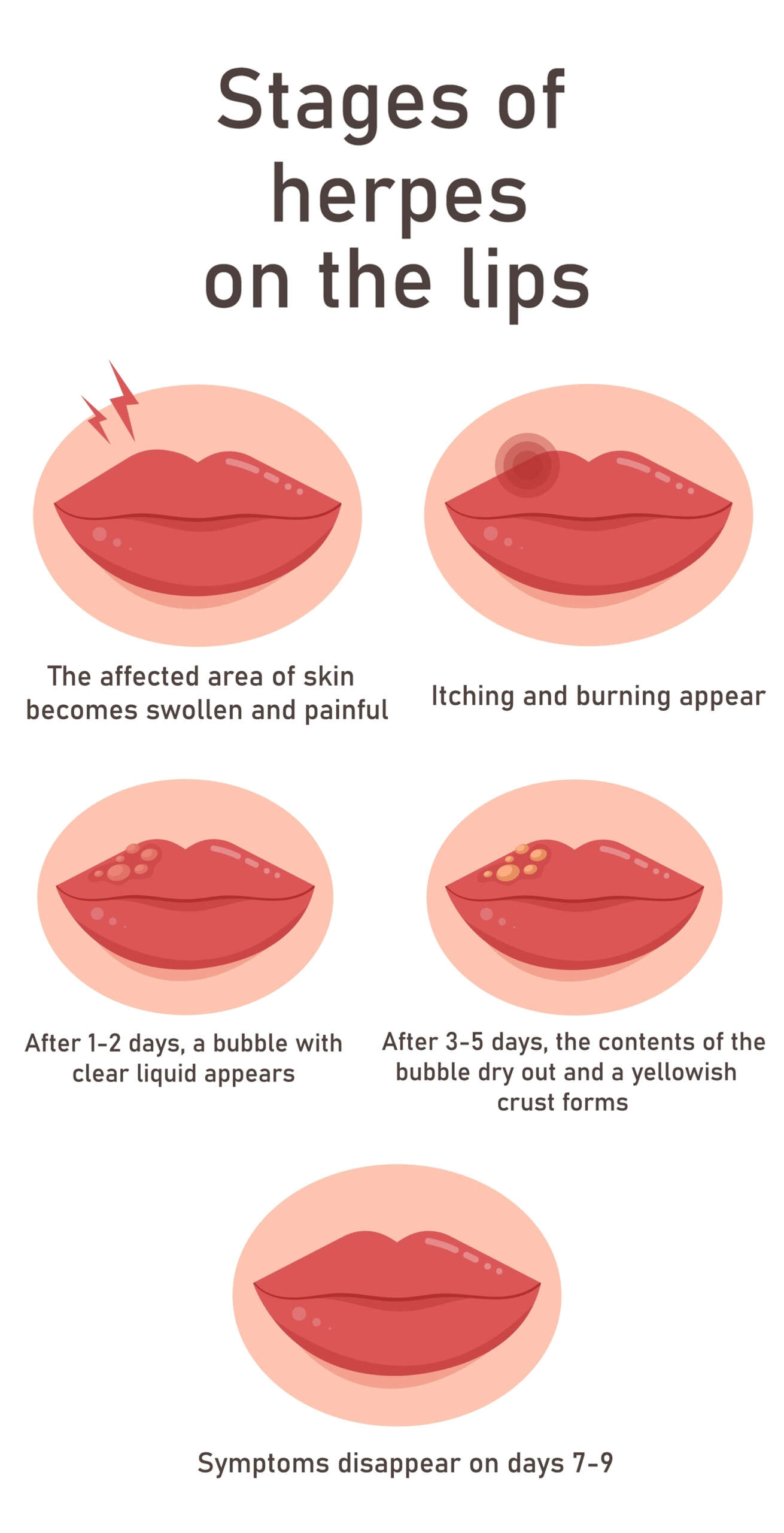 Know The Causes And Early Symptoms Of Herpes