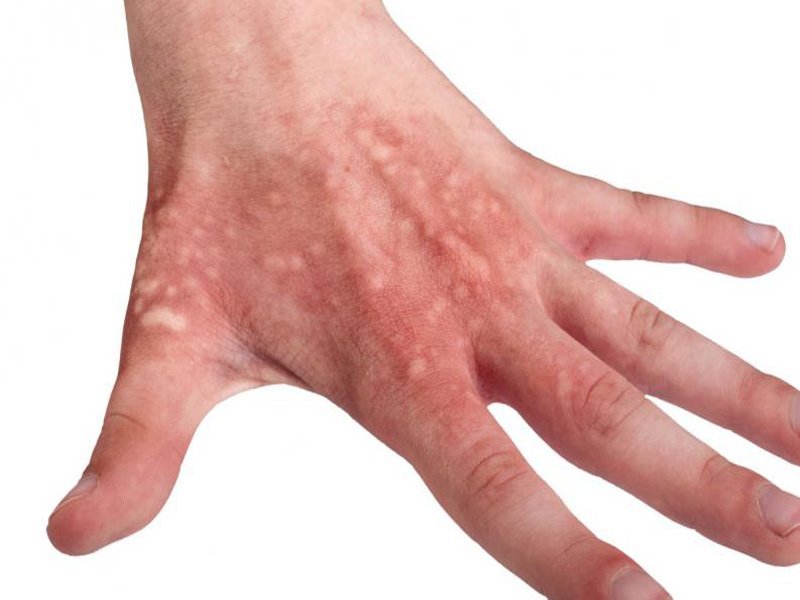 home remedies for minor burns