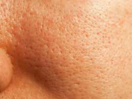 How To Get Rid Of Open Pores: 10 Practical Home Remedies!