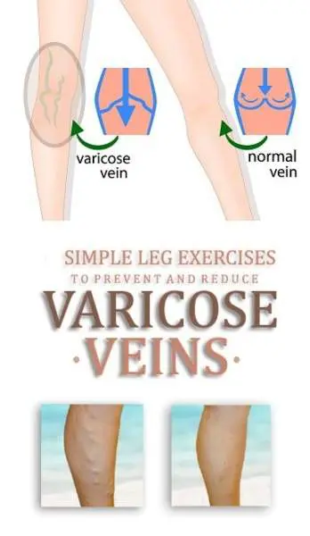 exercises for varicose veins)