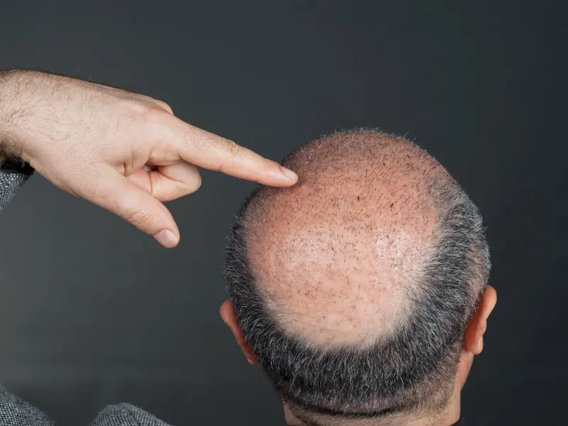 9 Best Hair Transplant Centers In Jaipur | Styles At Life
