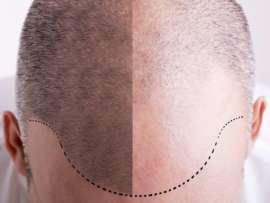 Hair Transplantation: Types, Side Effects, and Success Rates!