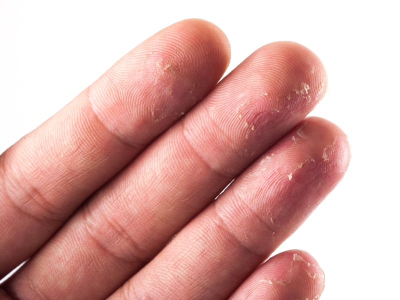 Home Remedies To Get Rid Of Peeling Fingertips