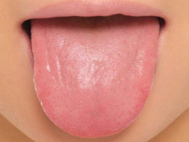 How To Treat Pimples on Tongue?