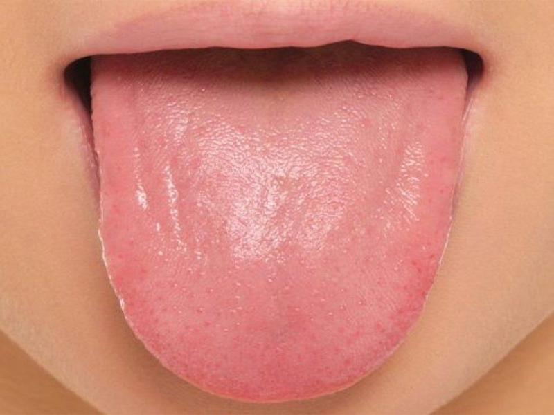 How To Treat Pimples On Tongue