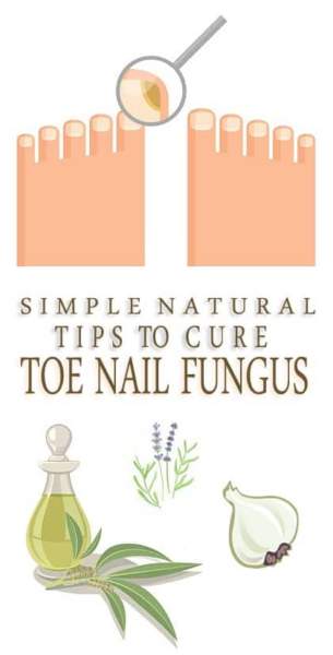 How To Get Rid Of Toenail Fungus (1)