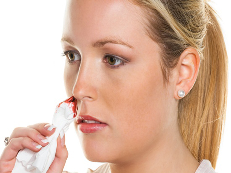 Nose Bleeding Symptoms