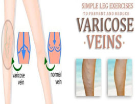 10 Best Exercises For Varicose Veins Treatment