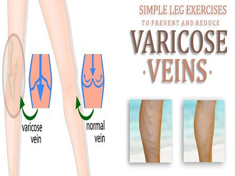 Exercises For Varicose Veins