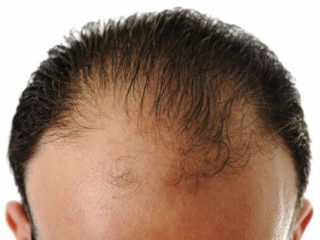 Frontal Hair Loss – How to Treat and Prevent?