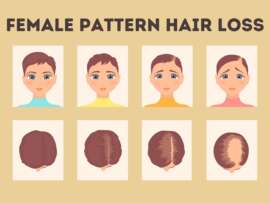 Female Pattern Hair Loss – What is It and How to Tackle It
