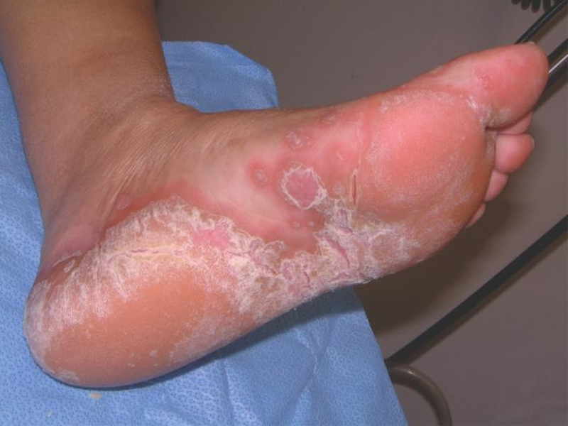 Best Home Remedies For Fungal Infections