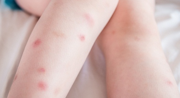 home remedies for bed bug bites