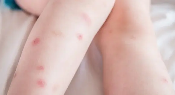 Natural Home Remedies for Treating Bed Bug Bites.jpg