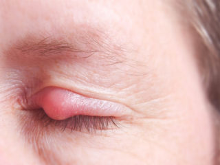 Natural Remedies To Get Rid Of Eye Stye