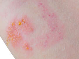13 Common Skin Rashes That Can Occur to any Body