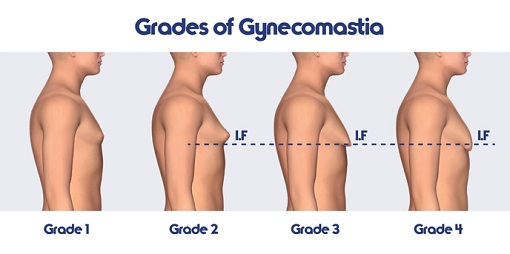 Types of Gynecomastia in Men