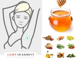 Painful Lump in Armpit – Causes, Symptoms & Natural Treatments