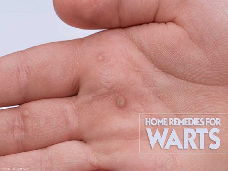 wart removal home remedies