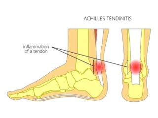 Top 10 Home Remedies to Prevent Achilles Tendon Pain