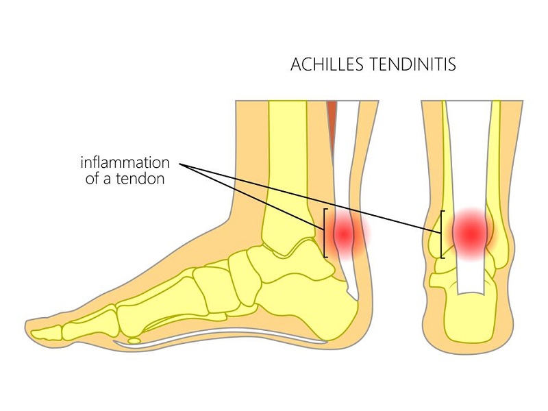 home remedies for Achilles Tendon Pain