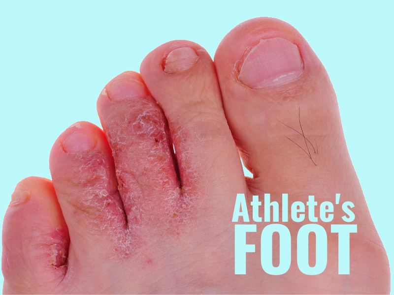 Best Natural Treatments For Athlete's Foot