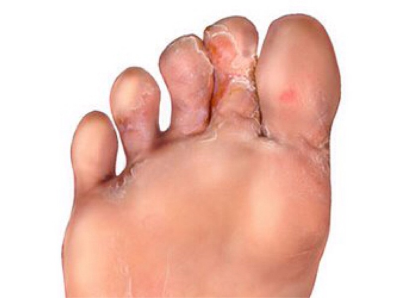 Home Remedies For Athlete's Foot