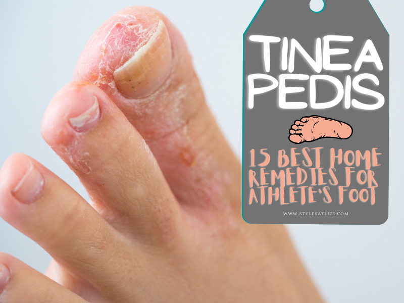 How To Cure Athlete's Foot At Home Fast