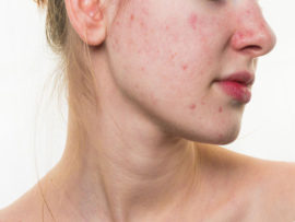 9 Home Remedies To Get Rid of Heat Boils on Face