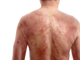 9 Best Home Remedies for Dermatitis