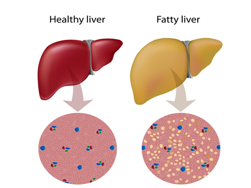causes of non alcoholic fatty liver