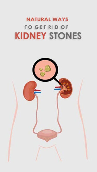 best remedy for kidney stones