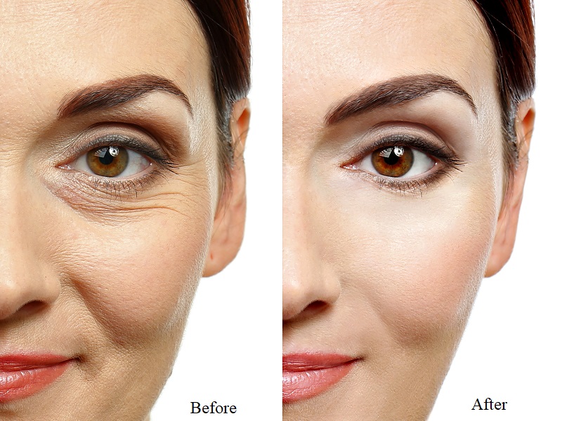 How To Get Rid Of Under Eye Wrinkles