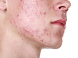 How to Get Rid of Hormonal Acne – Causes & Treatments!