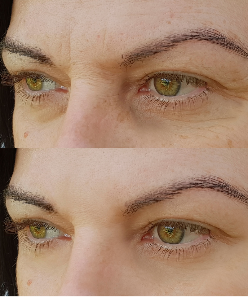 Natural Remedies For Under Eye Wrinkles And Fine Lines