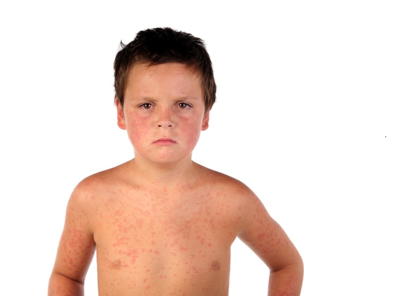 Measles Symptoms, Causes And Treatment