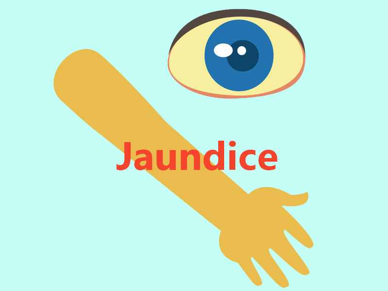 Causes And Signs Of Jaundice