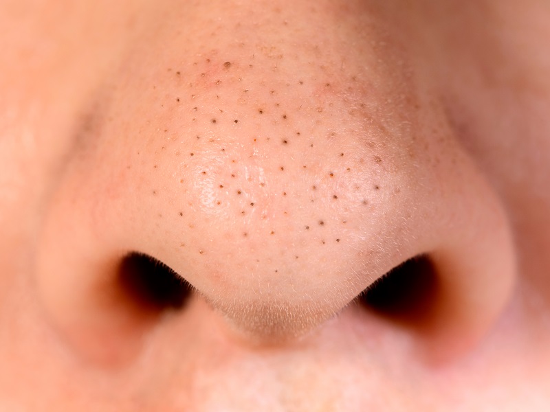 How To Remove Nose Blackheads At Home