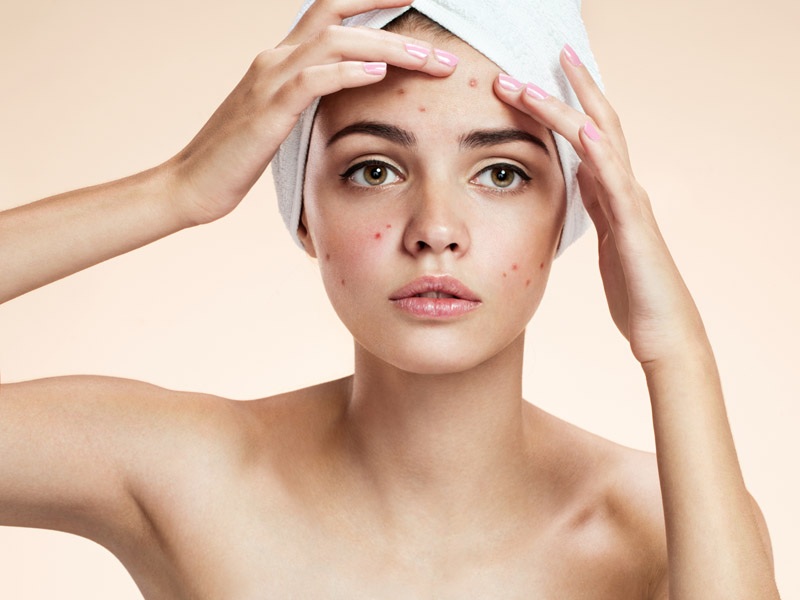 How To Avoid Pimples Causes And Tips For Prevention