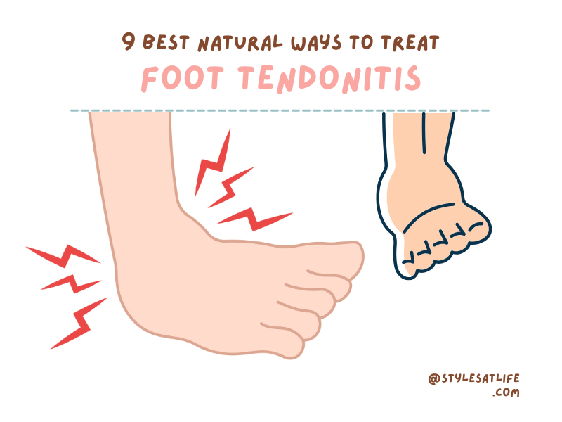 Natural Ways To Treat Foot Tendonitis At Home