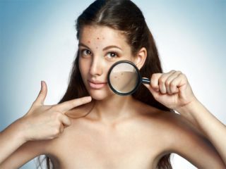 How to Treat Oily Skin Pimples at Home? – Causes and Remedies!