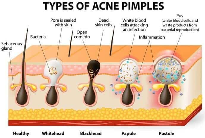 Types Of Pimples