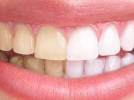 Yellow Teeth: 20 Best Home Remedies for Teeth Discoloration